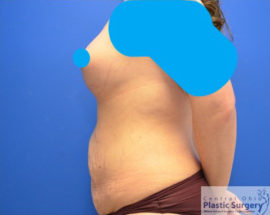 Breast Augmentation