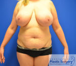 Breast Reduction