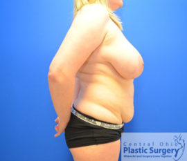 Breast Reduction