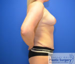 Breast Reduction