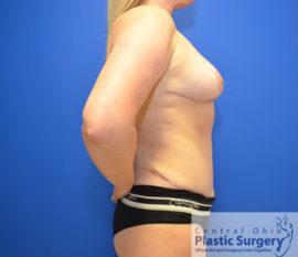 Breast Reduction/Breast Lift