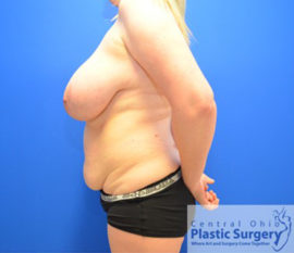 Breast Reduction