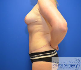 Breast Reduction/Breast Lift