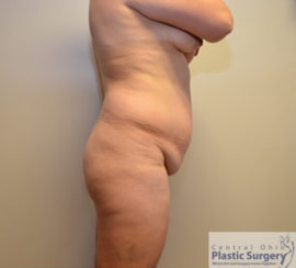 Butt Lift/Brazilian Butt Lift (BBL)