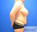 Liposuction