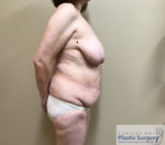 Breast Reduction/Breast Lift