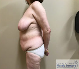 Breast Reduction/Breast Lift