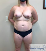 Breast Reduction/Breast Lift