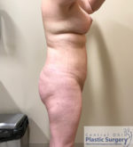 Breast Reduction/Breast Lift