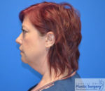 Facelift & Necklift