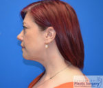 Facelift & Necklift