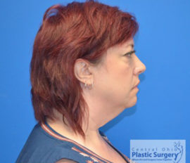 Facelift & Necklift