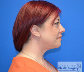 Facelift & Necklift