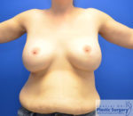 Breast Augmentation with Lift