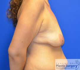 Breast Augmentation with Lift