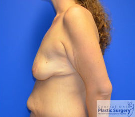 Breast Augmentation with Lift
