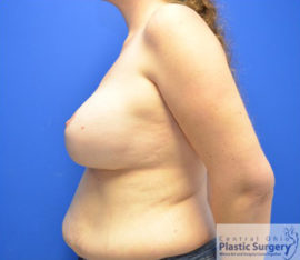Breast Augmentation with Lift