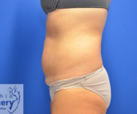 Coolsculpting