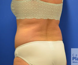 Coolsculpting