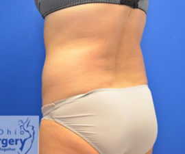 Coolsculpting