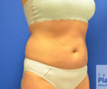 Coolsculpting