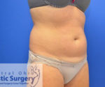 Coolsculpting
