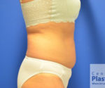 Coolsculpting