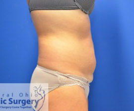 Coolsculpting