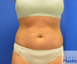 Coolsculpting