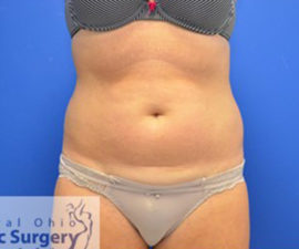 Coolsculpting