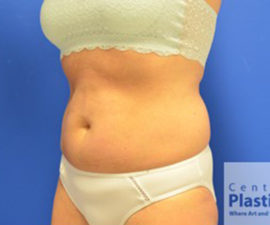 Coolsculpting