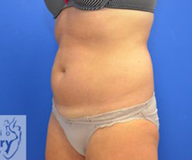 Coolsculpting