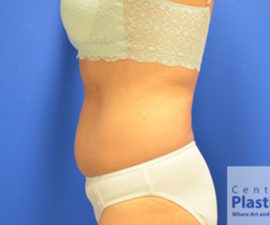 Coolsculpting