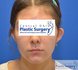 Otoplasty