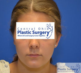 Otoplasty