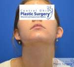 Otoplasty