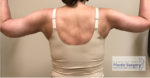 Arm Lift