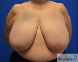 Breast Lift