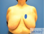 Breast Reduction/Breast Lift