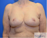 Breast Reduction/Breast Lift