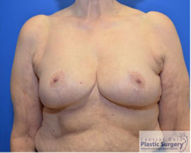 Breast Reduction/Breast Lift