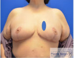 Breast Reduction/Breast Lift