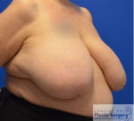 Breast Reduction/Breast Lift