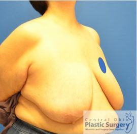 Breast Reduction