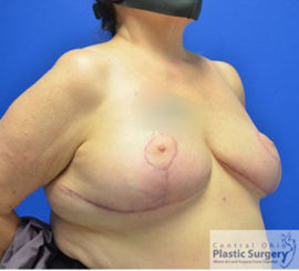 Breast Lift