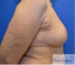 Breast Reduction/Breast Lift