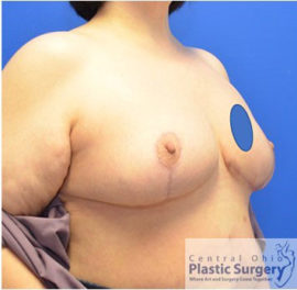 Breast Lift