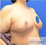 Breast Reduction/Breast Lift