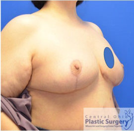 Breast Reduction/Breast Lift