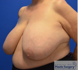 Breast Lift